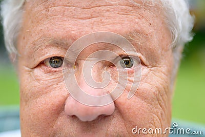 Elderly man suffering from anisocoria showing unequal pupils Stock Photo