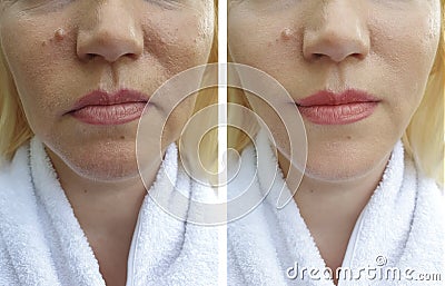 Elderly woman`s face wrinkles lifting collagen dermatology regeneration treatment therapy before and after procedures Stock Photo