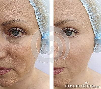 Elderly woman`s face wrinkles lifting dermatology regeneration treatment therapy before and after procedures Stock Photo