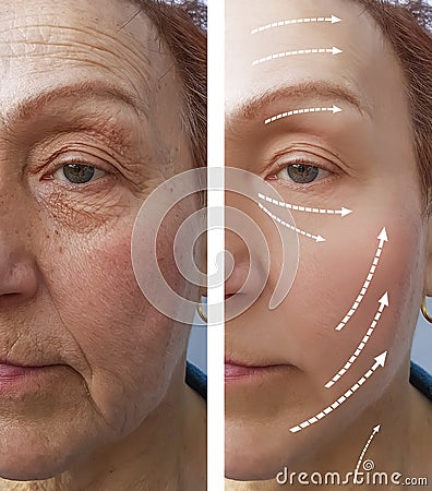 Elderly Woman wrinkles before after medicine contour tension hydrating the procedure effect regeneration Stock Photo