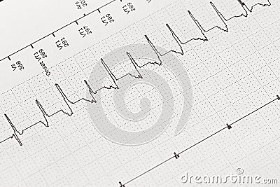 Electrocardiogram, Cardiac Arrhythmia Stock Photo