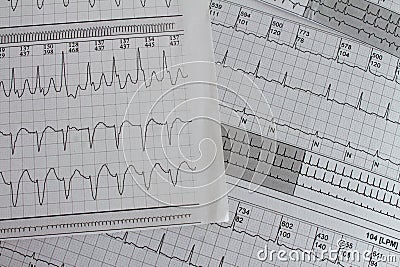 Electrocardiogram with cardiac arrhythmia. Patient with atrial fibrillation and atrial flutter Stock Photo