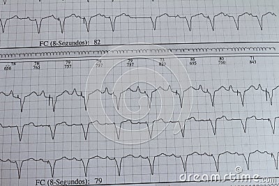 Electrocardiogram with cardiac arrhythmia. Patient with cardiac pacemaker Stock Photo