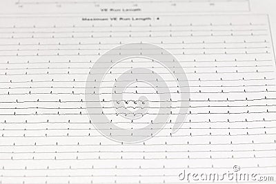 EKG chart Cardiac Arrhythmia on paper Stock Photo