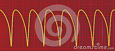 Electrocardiogram displaying ventricular tachycardia, 3D illustration Cartoon Illustration