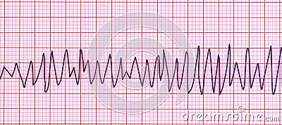 Electrocardiogram ECG displaying Torsades de pointes rhythm, 3D illustration Cartoon Illustration