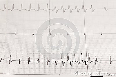 Electrocardiogram ECG / EKG with cardiac arrhythmia Stock Photo