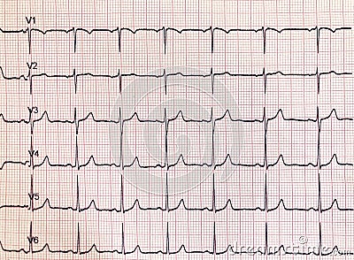 Electrocardiogram hospital examination. Sheet that represents a diagnostic test Stock Photo