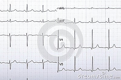 Electrocardiogram Stock Photo