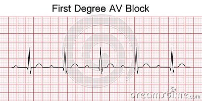 Electrocardiogram show first degree AV block pattern. Vector Illustration