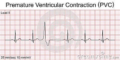 Electrocardiogram show Premature Ventricular Contraction PVC pattern. Vector Illustration