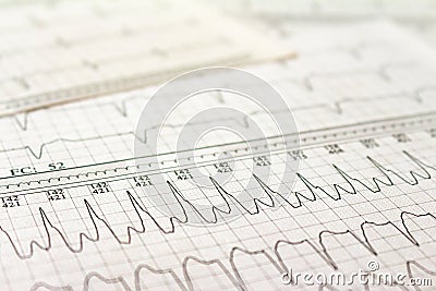Electrocardiogram strips with cardiac arrhythmias. Atrial fibrillation Selective focus on some beats. Free space to write Stock Photo