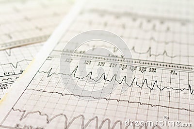 Electrocardiogram strips with cardiac arrhythmias. Ventricular tachycardia Selective focus on some beats. Free space to write Stock Photo