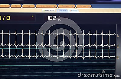 Electrocardiogram tracings on a cardiac monitor Stock Photo