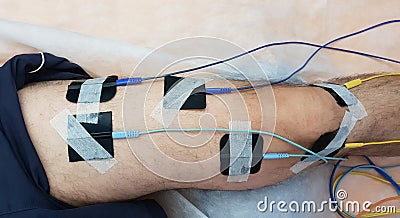 Electrostimulation of the quadriceps as a physiotherapy Stock Photo