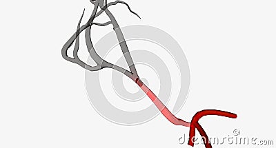 Embolism blockage in cerebral artery Stock Photo