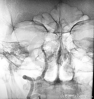 Embolization pavermian thrombosed aneurism scan Stock Photo