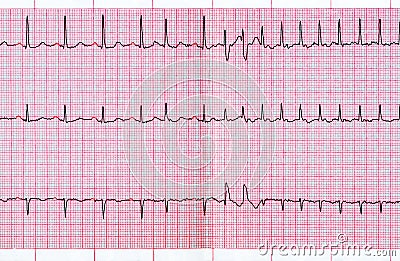 ECG with supraventricular extrasystole and short paroxysm of atrial fibrillation Stock Photo