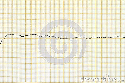 Emergency cardiology. ECG tape with ventricular fibrillation Stock Photo