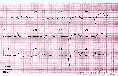 ECG with acute period of large-focal widespread anterior myocardial infarction Stock Photo