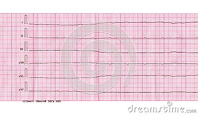 Emergency cardiology and resuscitation. ECG with ventricular asystole Stock Photo