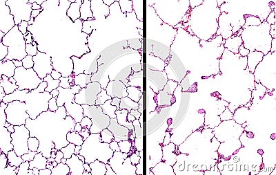 Emphysema in the lungs Stock Photo