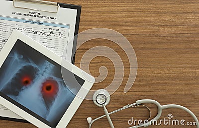 Emphysema x ray lung Stock Photo