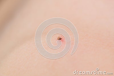 Encephalitis tick Stock Photo