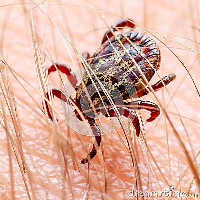 Encephalitis Tick Insect Crawling on Skin. Encephalitis Virus or Lyme Borreliosis Disease Infectious Dermacentor Tick Arachnid Stock Photo