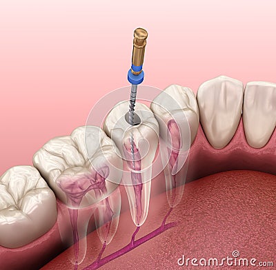 Endodontic root canal treatment process. Medically accurate tooth illustration Cartoon Illustration