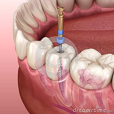 Endodontic root canal treatment process. Medically accurate tooth illustration Cartoon Illustration