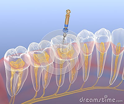 Endodontic root canal treatment process. Medically accurate tooth 3D illustration Cartoon Illustration
