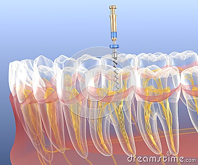 Endodontic root canal treatment process. Medically accurate tooth 3D illustration Cartoon Illustration