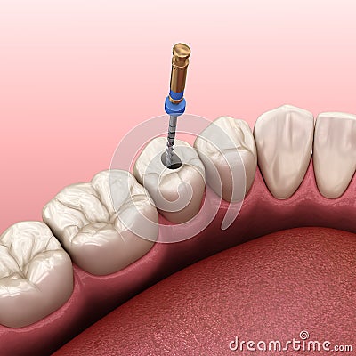 Endodontic root canal treatment process. Medically accurate tooth 3D illustration Cartoon Illustration