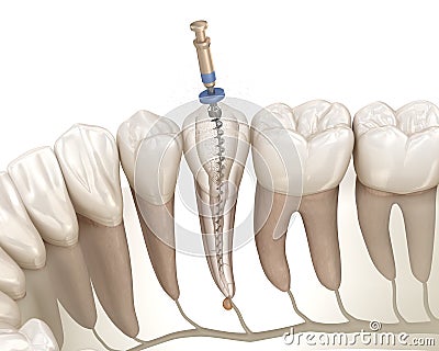 Endodontic root canal treatment process. Medically accurate tooth 3D illustration Cartoon Illustration