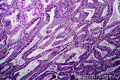 Endometrial adenocarcinoma, light micrograph Stock Photo