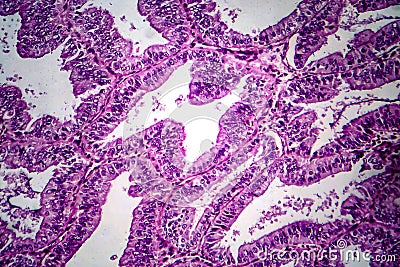 Endometrial adenocarcinoma, light micrograph Stock Photo