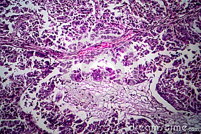 Endometrial adenocarcinoma, light micrograph Stock Photo