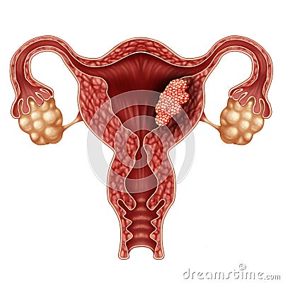 Endometrial Cancer Cartoon Illustration