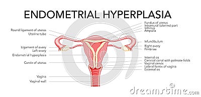 Endometrial hyperplasia Female reproductive system uterus with inscriptions medical diagram. Front view in a cut. Vector Illustration