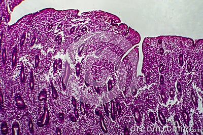 Endometrial hyperplasia, light micrograph Stock Photo