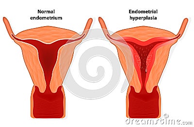 Endometrial hyperplasia Vector Illustration