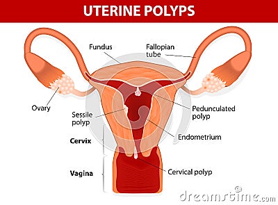 Endometrial polyp or uterine polyp Vector Illustration