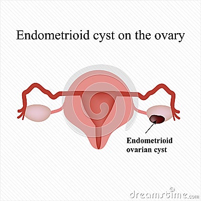 Endometrioid cyst on the ovary. Endometriosis. . Infographics. Vector illustration Vector Illustration