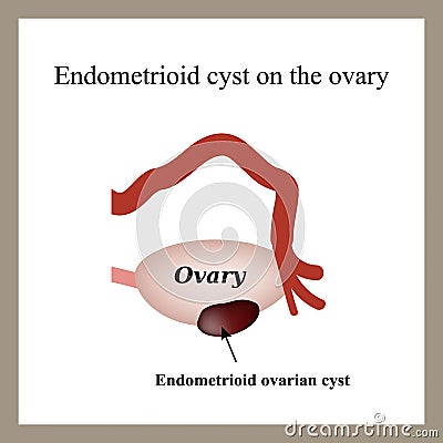 Endometrioid cyst on the ovary. Endometriosis. Ovary. Vector Illustration