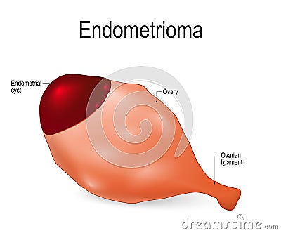 Endometrioma. endometrial cyst Vector Illustration