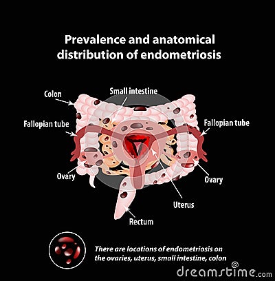 Endometriosis. The appearance of the disease . Endometrium. Colon. Small intestine. Infographics. Vector Illustration