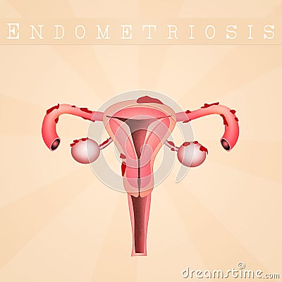 Endometriosis disease Stock Photo