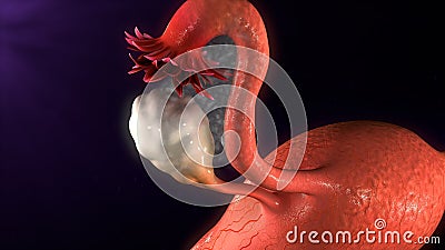 Endometriosis Stock Photo