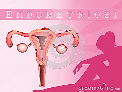 Endometriosis Stock Photo